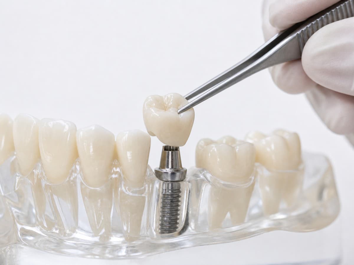 Coronas sobre implantes: lo que el odontólogo debe resolver antes de enviar el caso al laboratorio